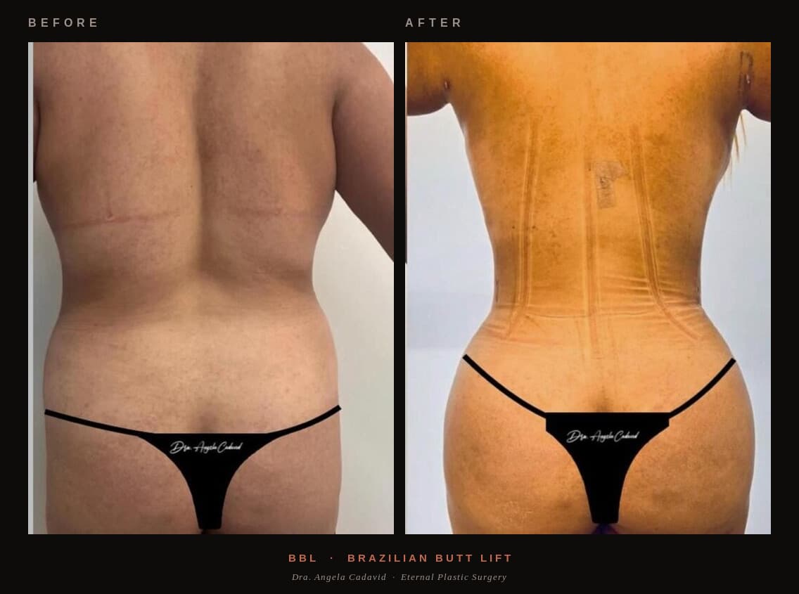 Before & After — BBL — Posterior