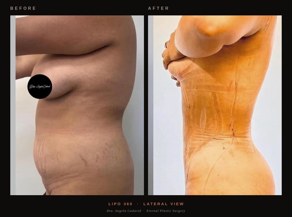 Before & After — Lipo 360° — Lateral