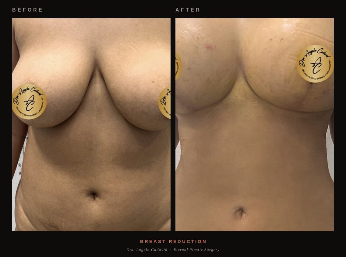 Before & After — Breast Reduction