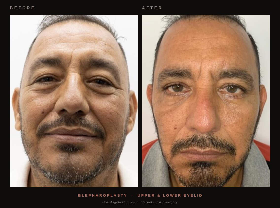 Before & After — Blepharoplasty
