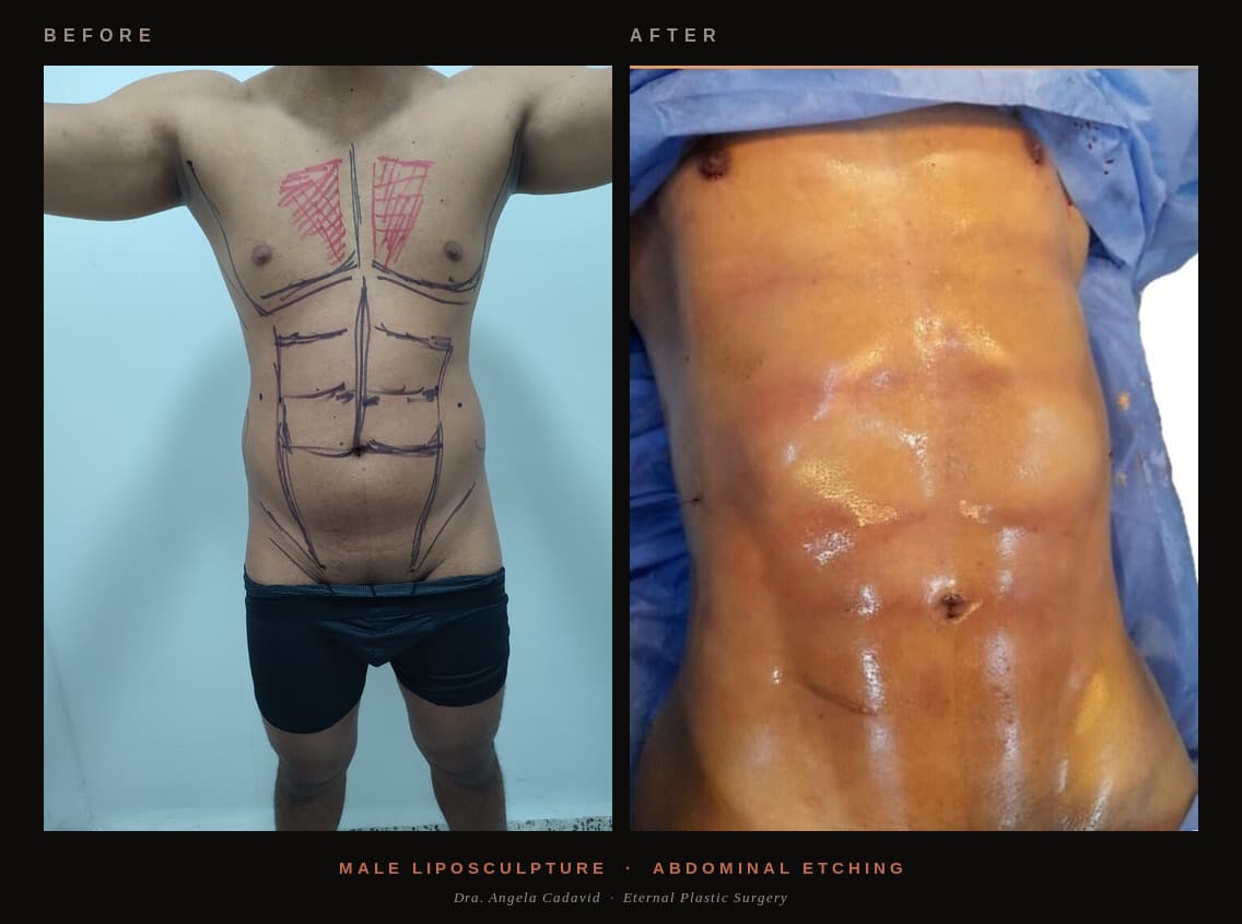 Before & After — Male Liposculpture